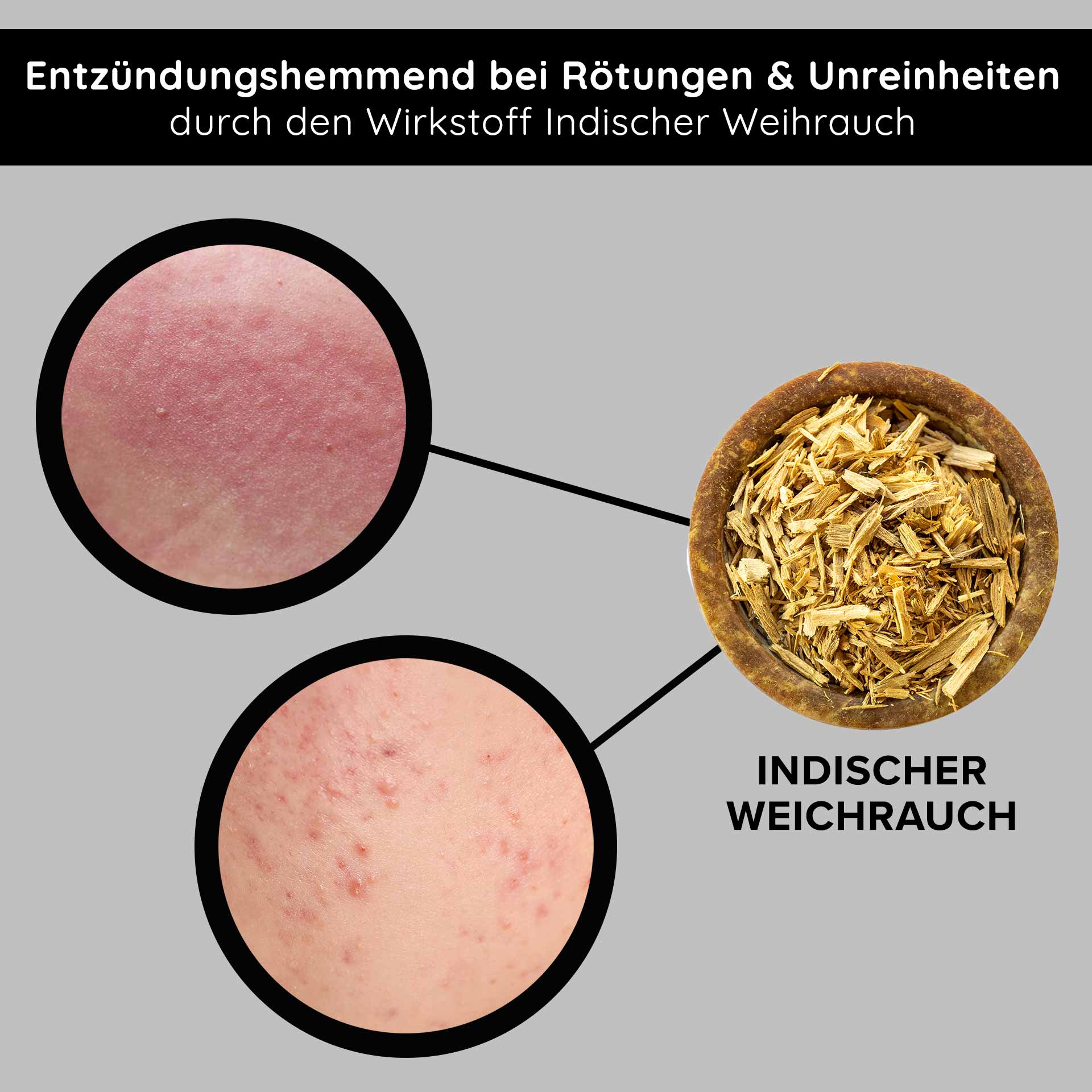 Tri-Peeling 50 ml Peeling agli enzimi e agli acidi della frutta Entzündungshemmendes Indischer Weihrauch zur Reduzierung von Rötungen und Unreinheiten, mit Nahaufnahmen von betroffener Haut.