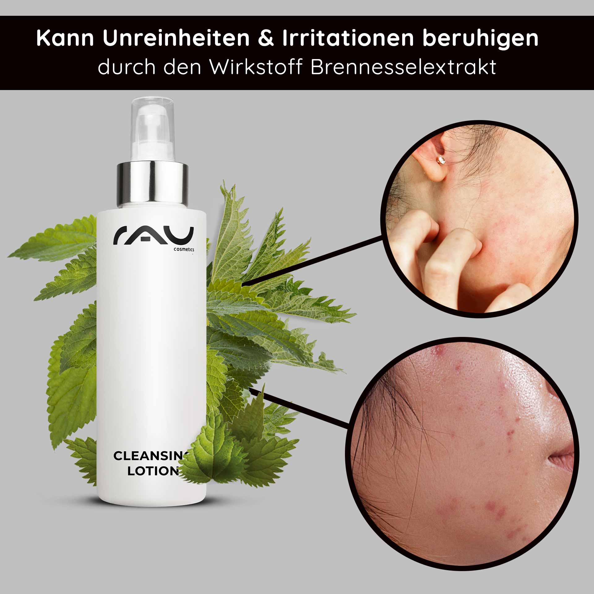 Lozione detergente 200 ml - Lozione detergente profonda Flasche der RAU-Reinigungslotion mit Brennnesselblättern im Hintergrund, die die Vorteile bei der Linderung von Unreinheiten und Reizungen hervorhebt und Nahaufnahmen von Haut mit Unreinheiten zeigt.